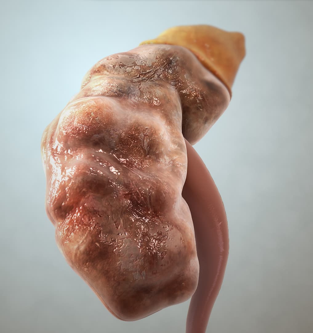 Chronic Kidney Disease — editorial portrait