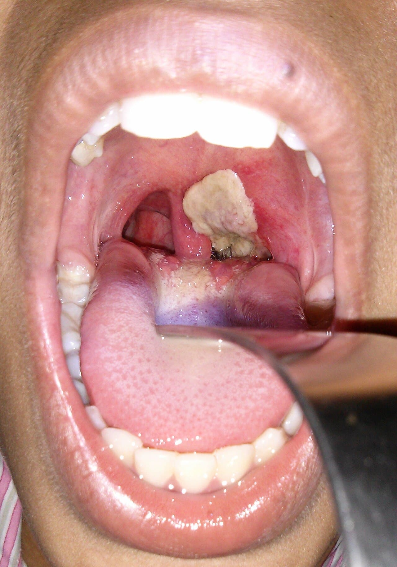 Diphtheria — editorial portrait